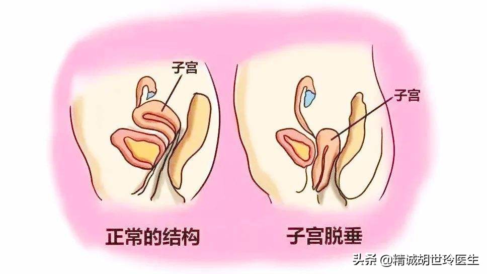 盆底肌无力与子宫脱垂能正常怀孕吗？