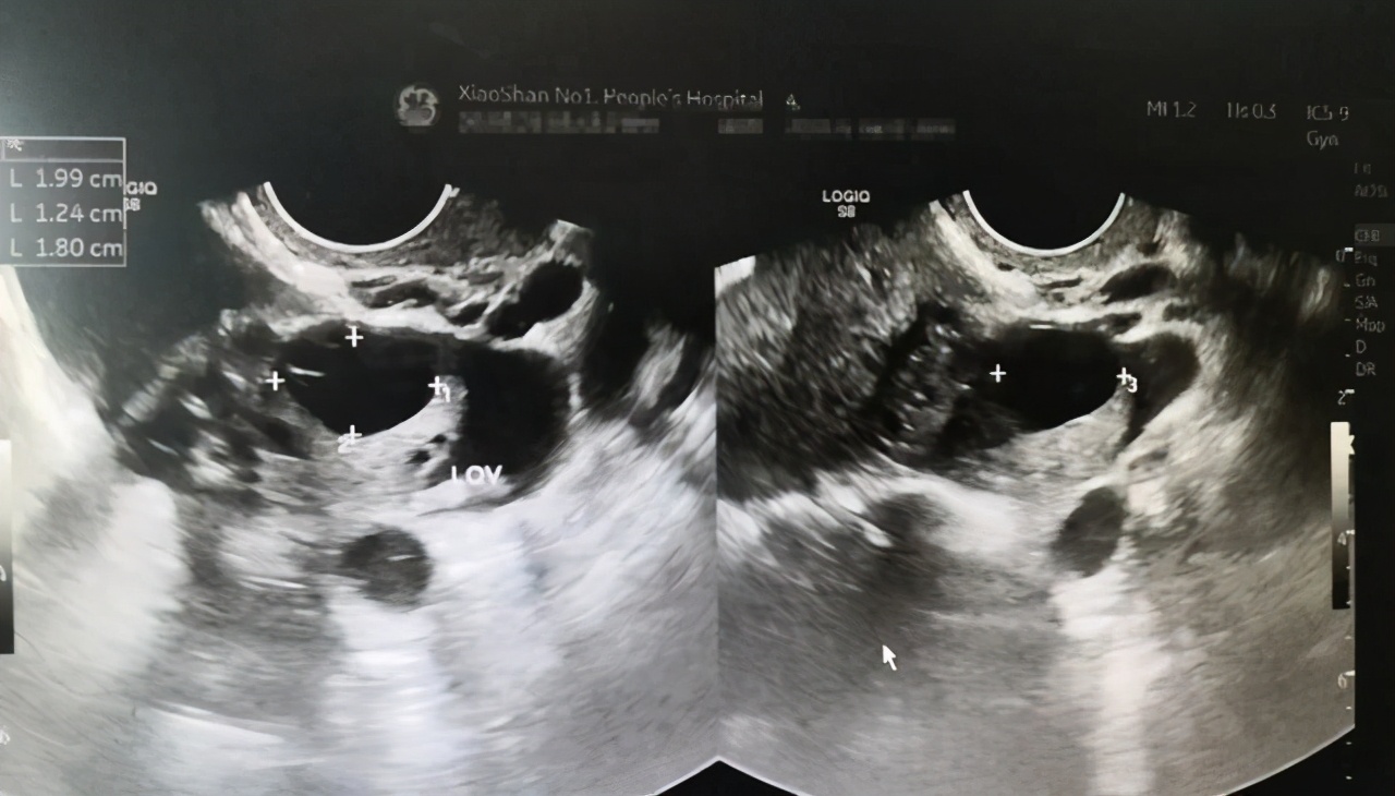 25岁女子黄体破裂的真实例子,黄体破裂18岁女孩
