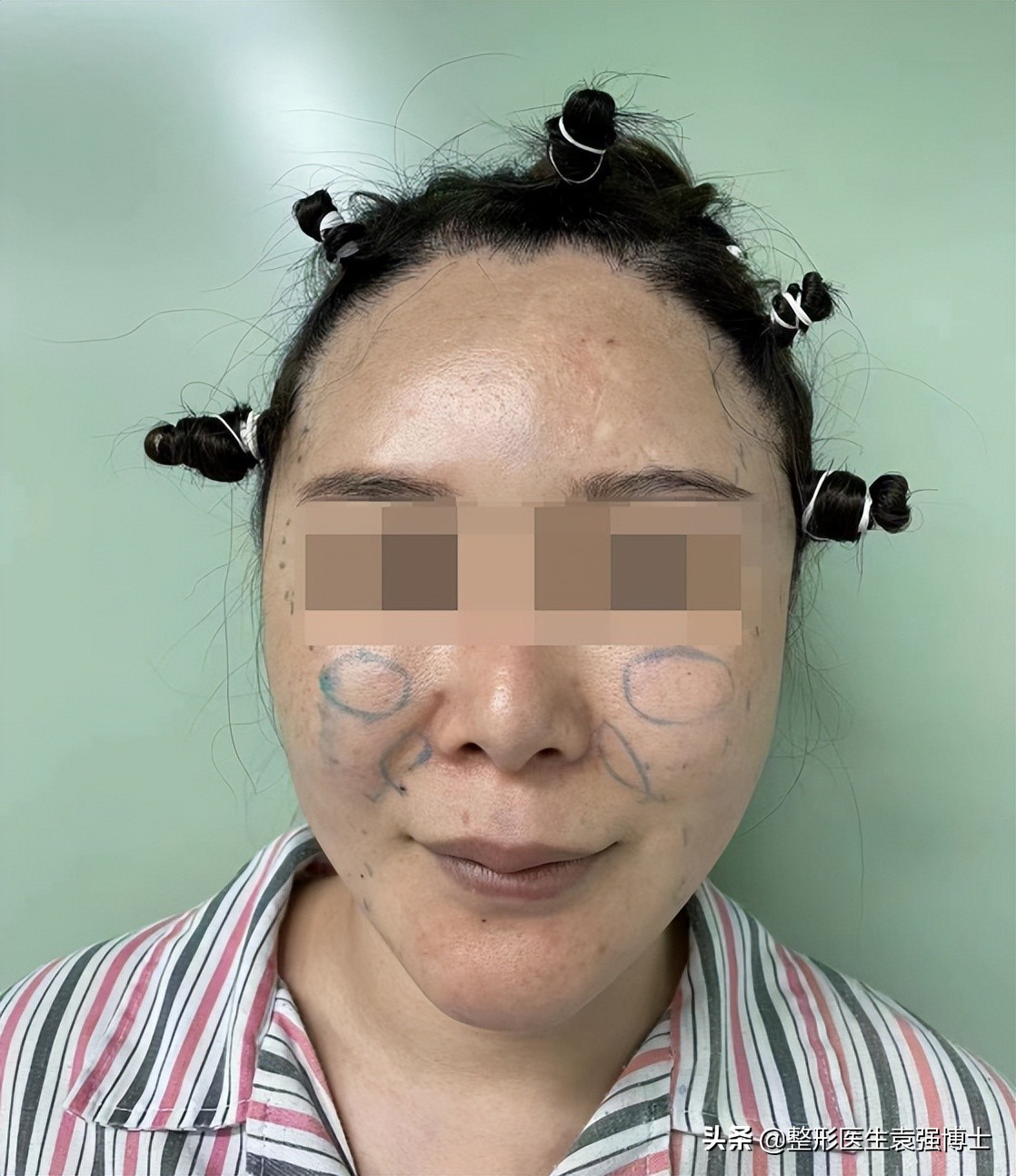 女子整容上瘾取出800颗假体,女子疯狂整容100次成芭比疯狂丰唇