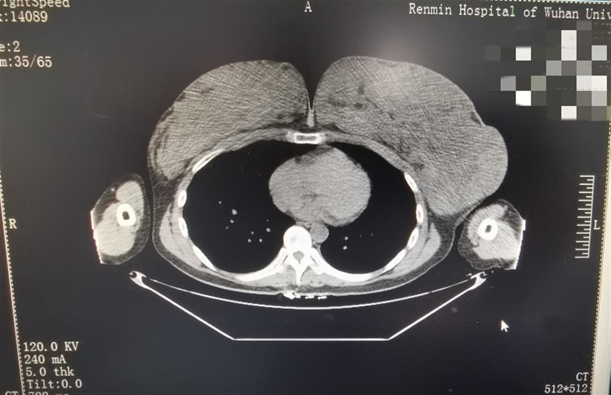什么是巨乳症？罕见的巨乳症，到底是什么原因造成的？