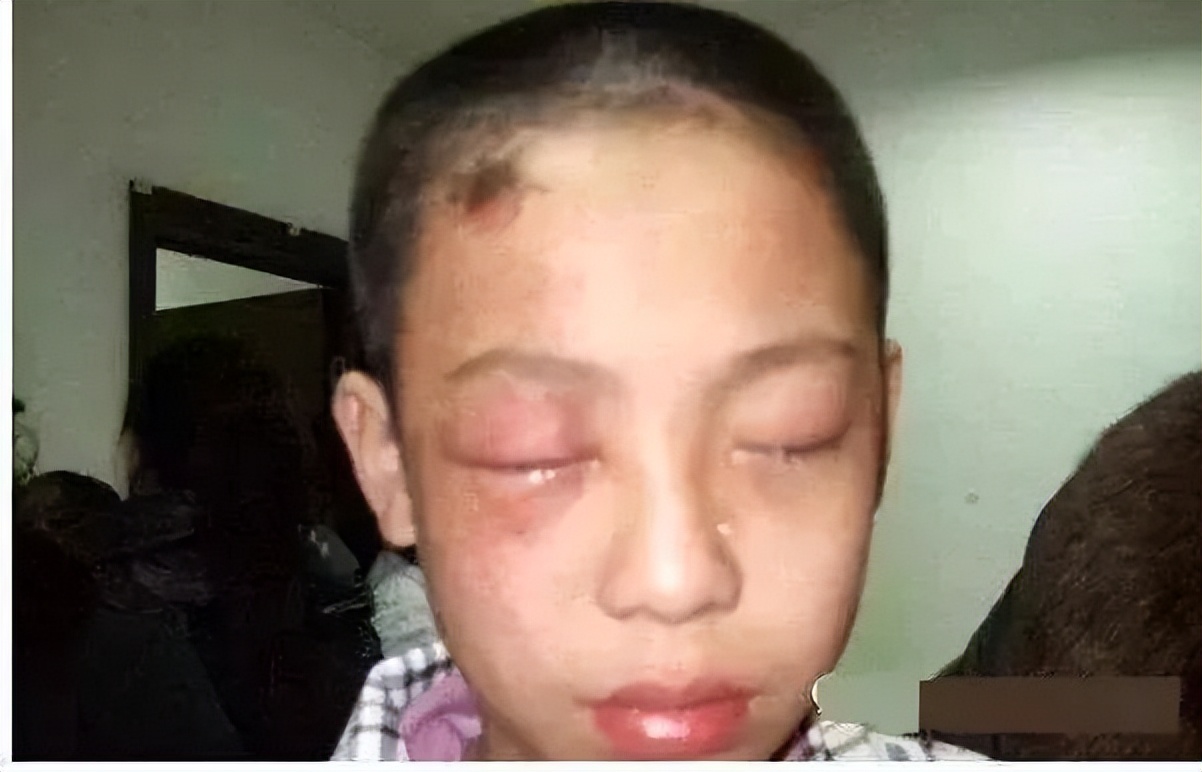 孩子眼球20分钟被熔化,小孩眼珠被熔化了怎么办