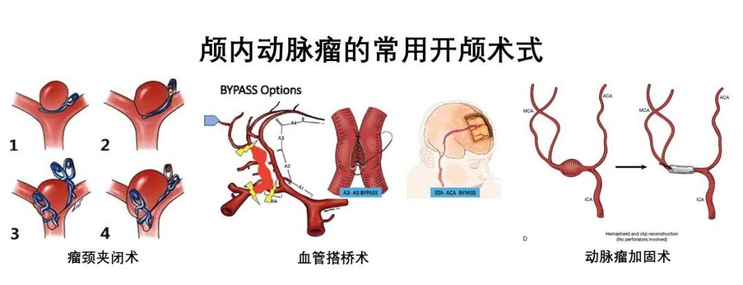 脑动脉瘤是否必须手术,脑动脉瘤必须手术治疗吗
