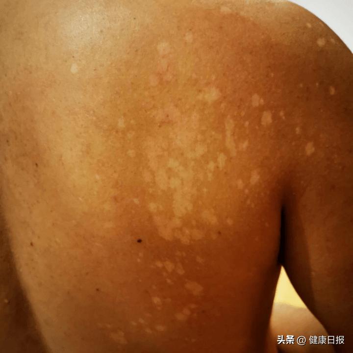 宝宝脖子有白色的圆点,宝宝皮肤上白色圆圈