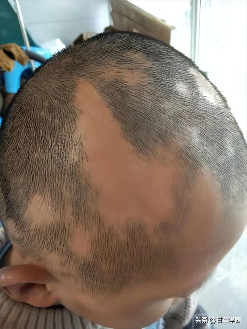 复方甘草治疗斑秃,甘草煮水治疗斑秃效果好吗