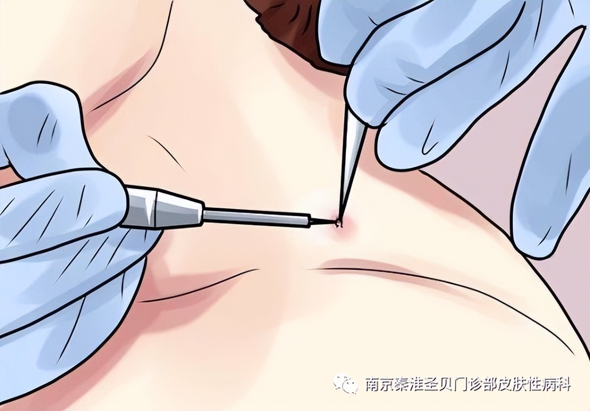 尖锐湿疣激光治疗影响精子质量吗,尖锐性湿疣治疗用什么方法最好