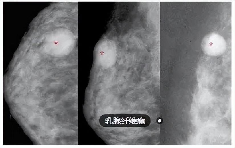 乳腺纤维瘤年轻女性发病率,19岁女孩乳腺纤维瘤多大切除好