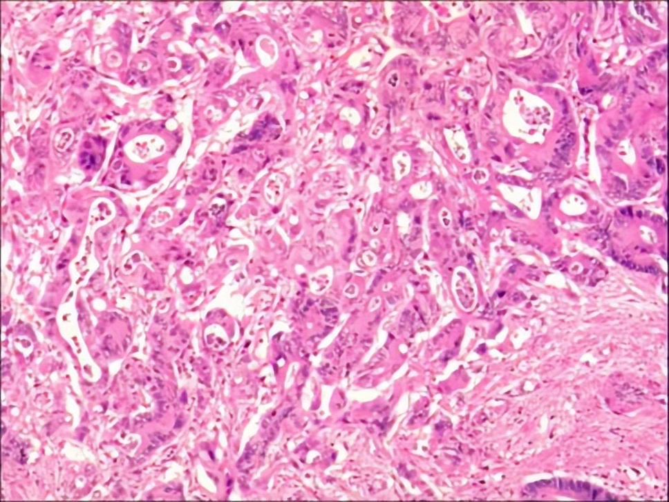 多原发癌症转移,多原发直肠癌