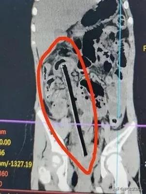 老人从高处跌落昏迷,老人不慎从台阶摔下躺在地上