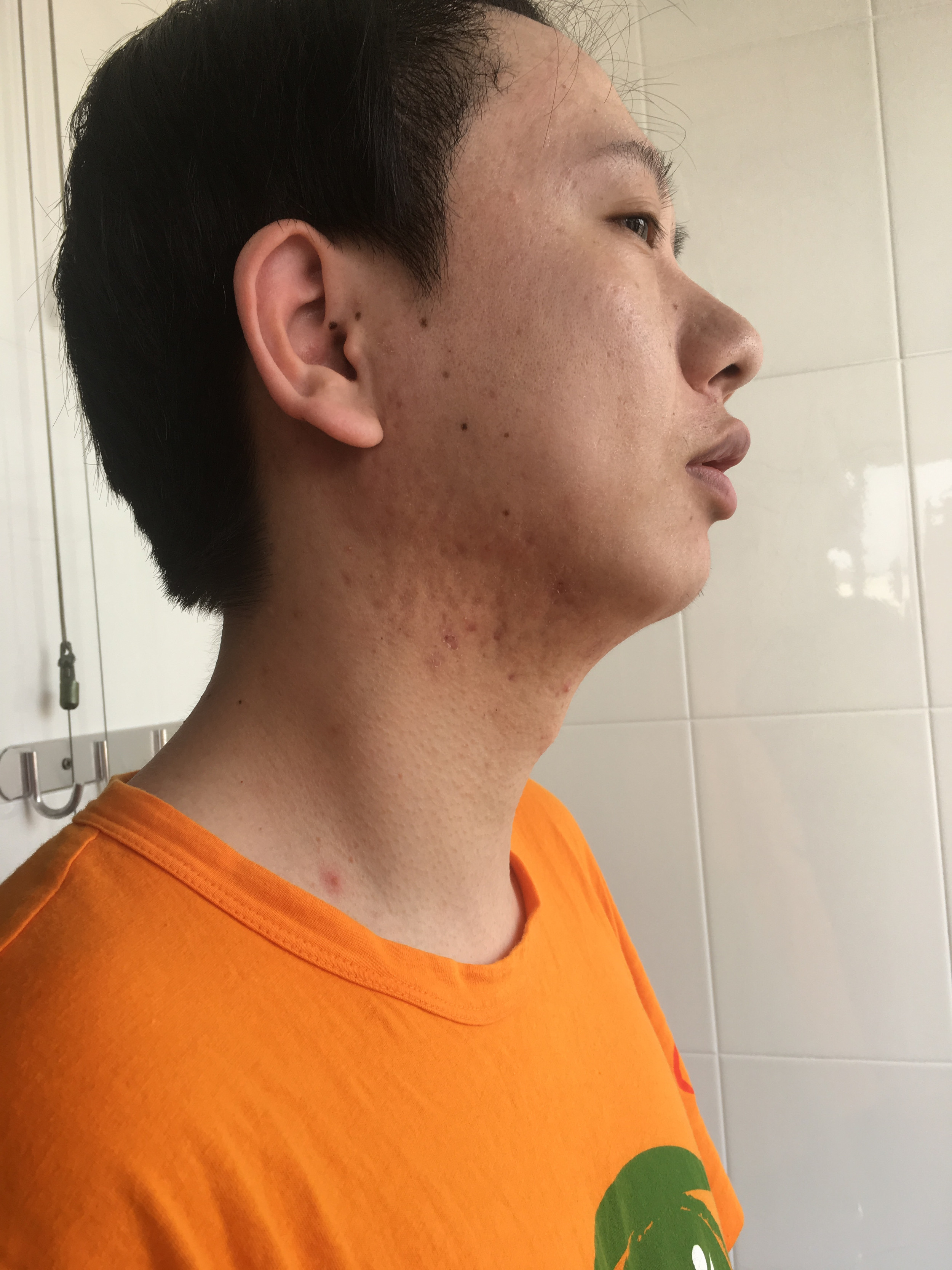 痘印痘坑做微针有效果吗,小伙子痘坑修复亲身经历