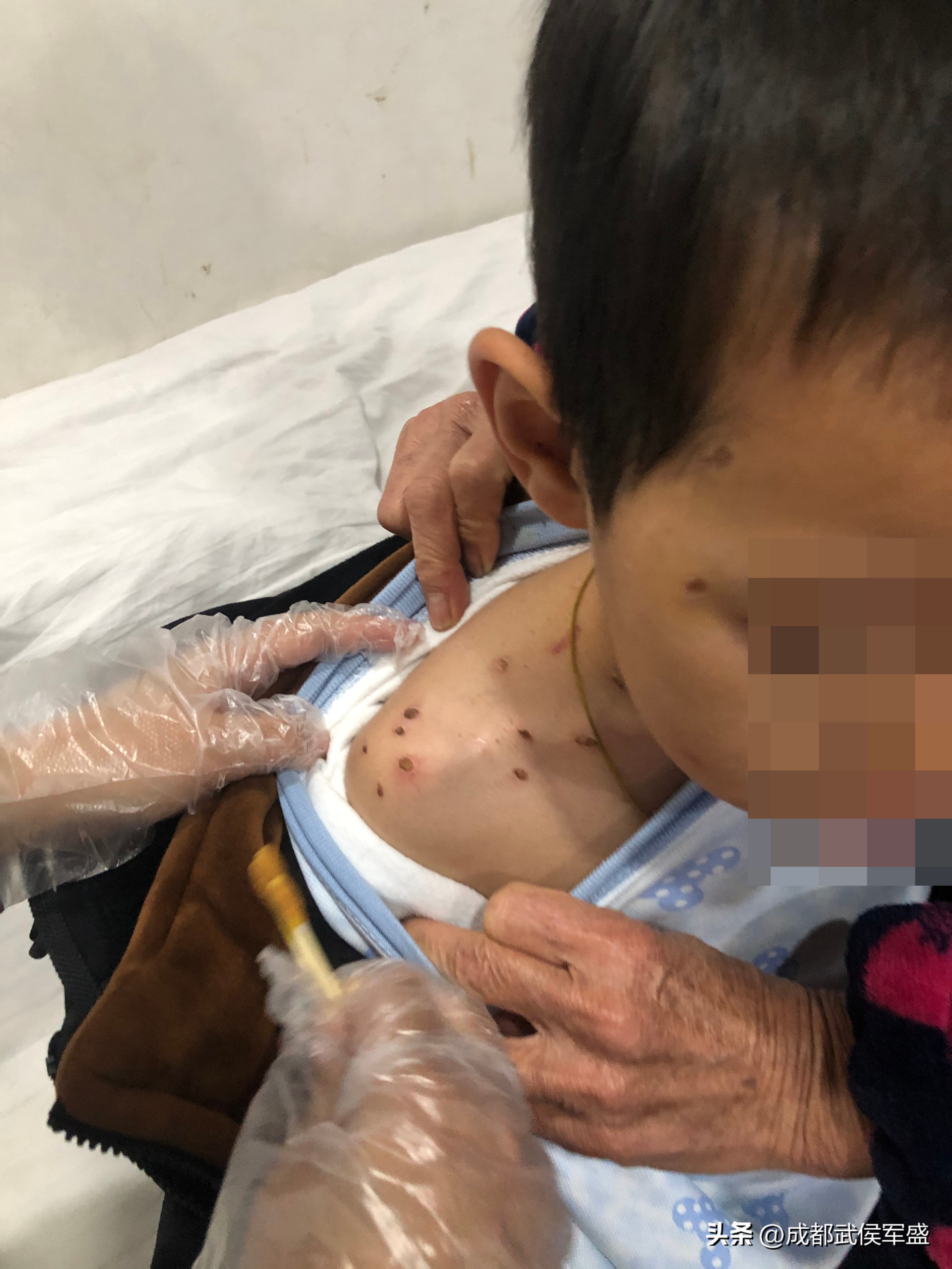 6岁男童被父亲烟头烫,癫痫发作被火烫伤的男孩