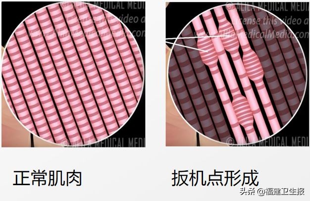 莫名疼痛抗生素也无效,被疑精神病!没想到是…女性注意了