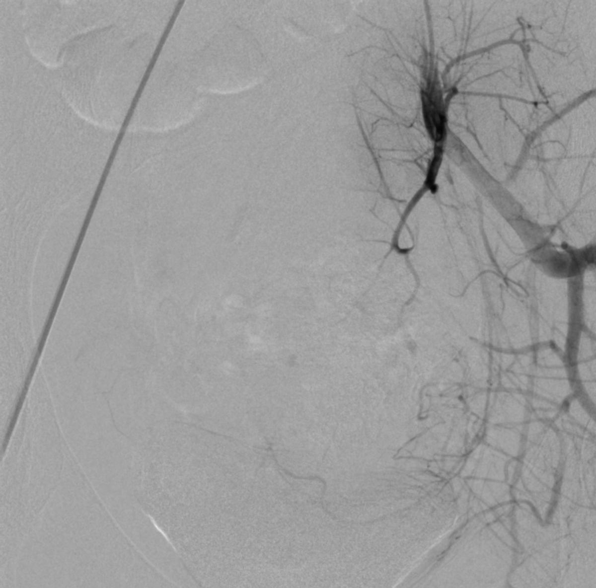 14岁女孩PROS综合症伴月经出血不止介入治疗病例