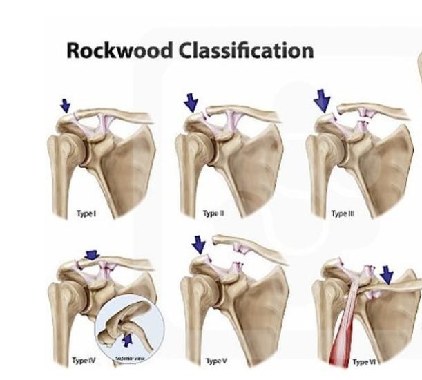 肩锁关节脱位手术多久能干体力活,左肩锁关节脱位拆钢板后多久恢复
