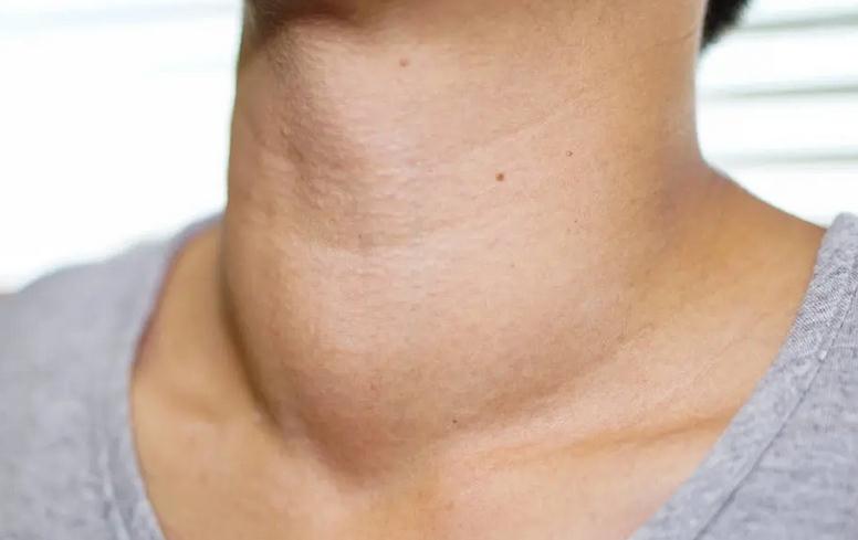 脖子里有结节是良性还是恶性,脖子上有结节吃什么药治疗