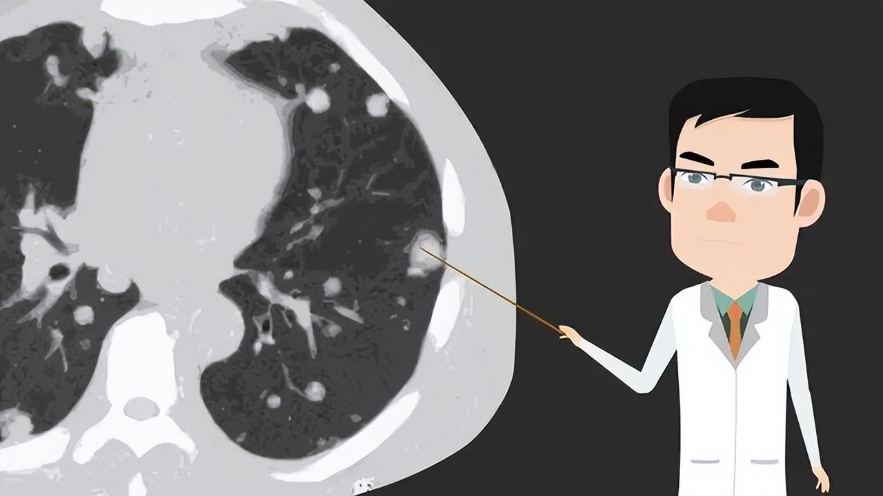 肺结节治疗方法及药方,宣医科普大课堂