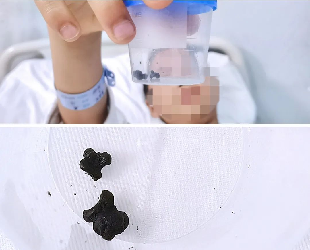 儿童胆结石的原因及解决方法,小孩胆结石有什么办法解决