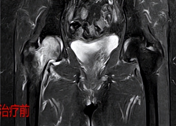 骨冲击波治疗仪,治骨疼痛最特效药方