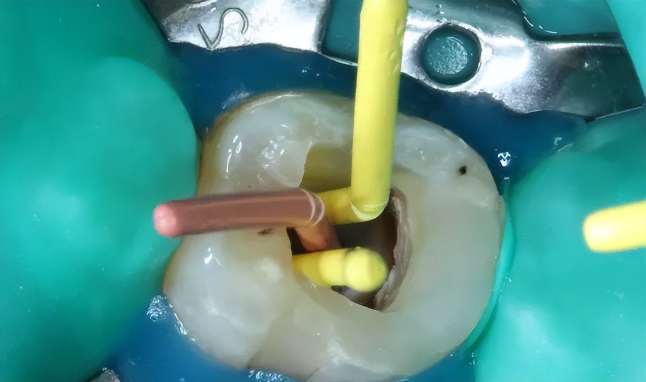 怎样知道牙髓有没有坏死,怎样判断牙髓坏死了