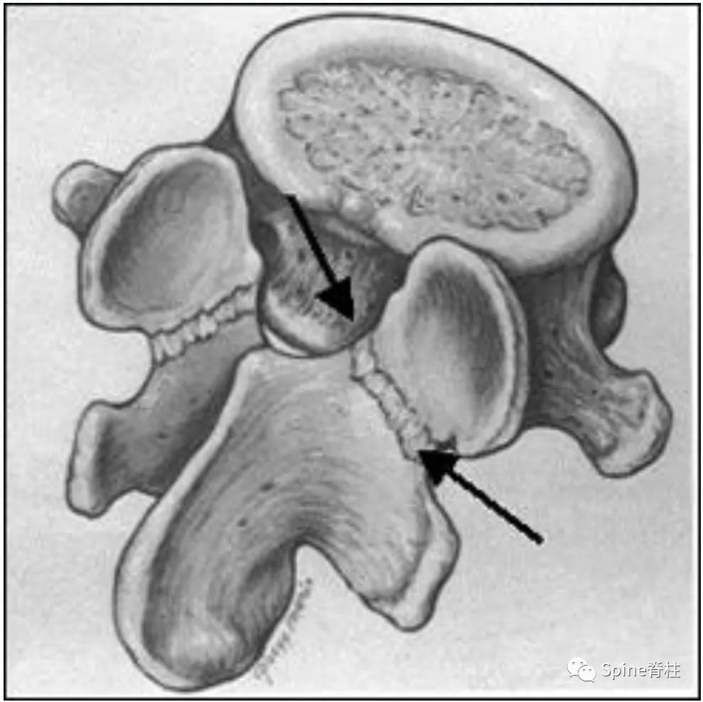 轻度峡部裂和重度峡部裂的区别,真性峡部裂和假性峡部裂