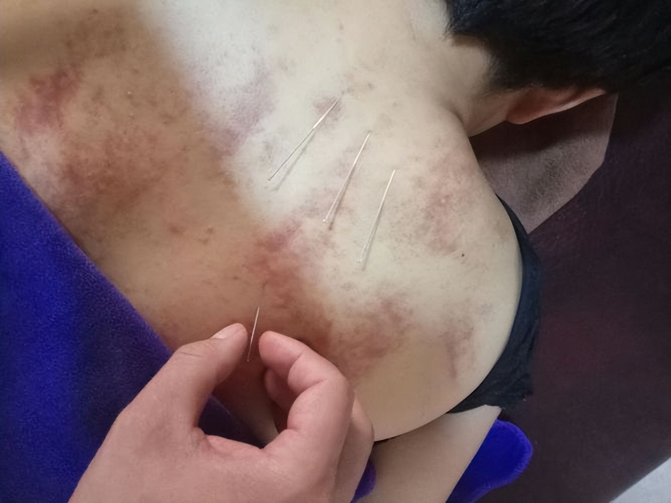 中医脚底筋膜炎如何彻底治愈,筋膜炎肩部最快的治疗方法中医