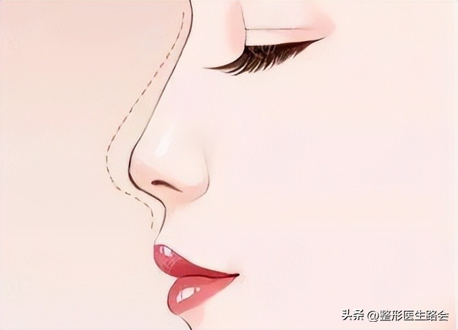 塌鼻子做什么样的鼻子安全,塌鼻子应该选择哪种隆鼻