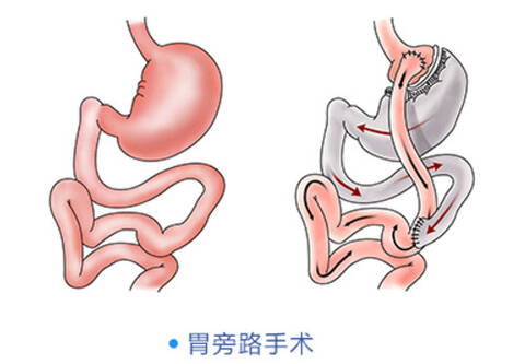 胃旁路手术减重平台期是多久,减重手术有哪些方法以及优缺点