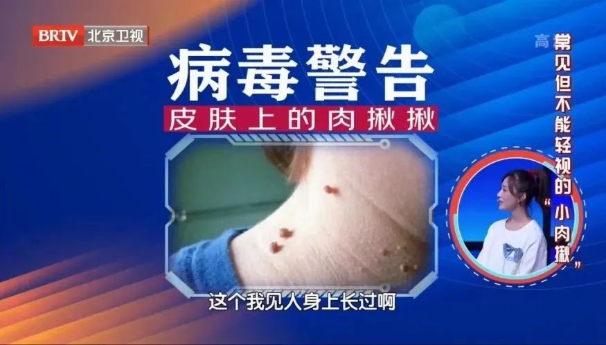 皮肤上的小肉疙瘩能自己弄下来吗,皮肤抠烂的硬疙瘩不好咋办