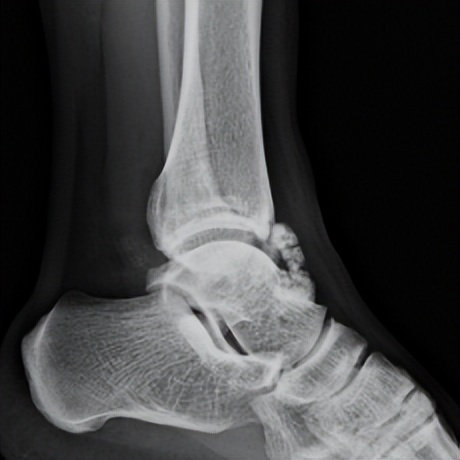 脚踝扭伤的处理方法和康复,脚踝扭伤立即进行的正确处理方法