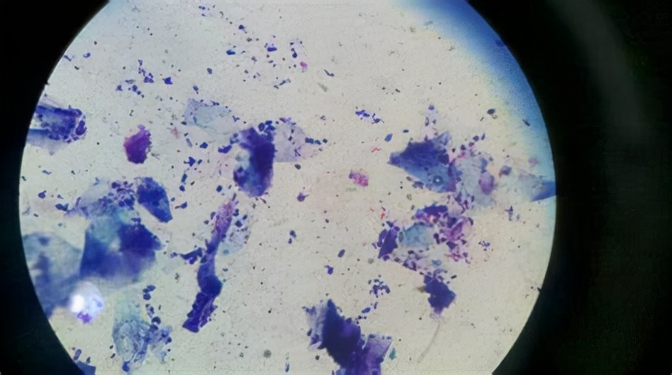 如何改善头皮屑用什么洗发水,如何改善头皮屑