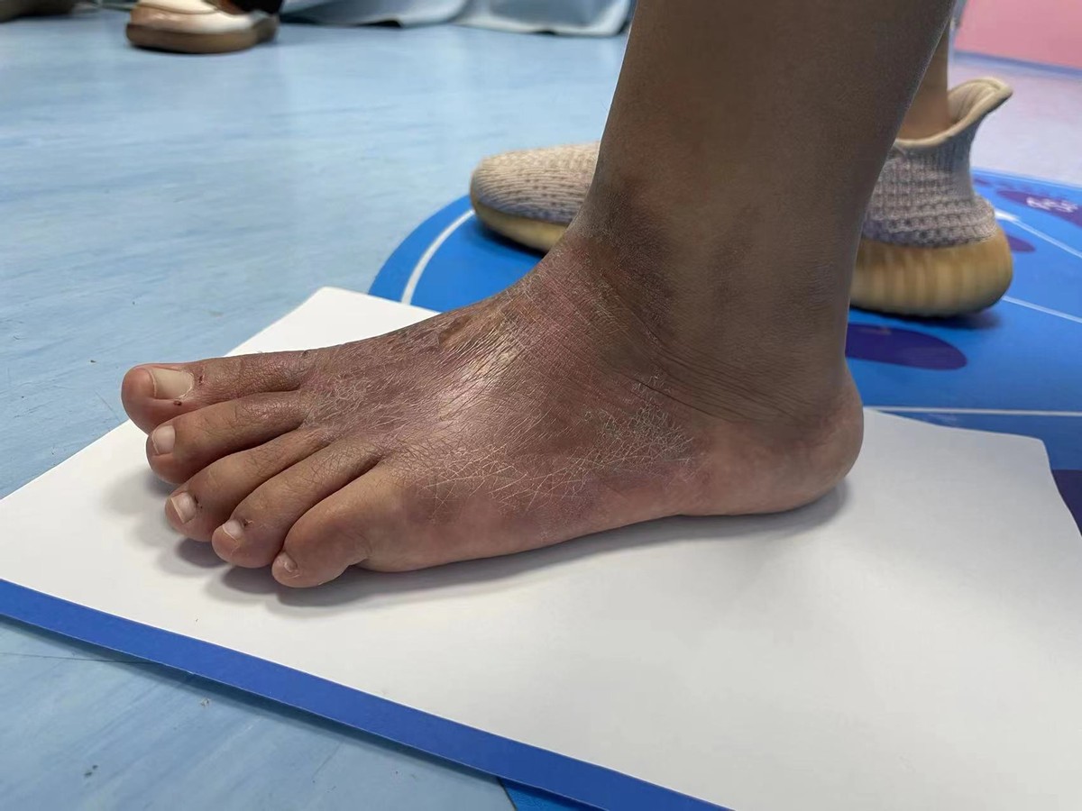 脚底板血管瘤介入治疗,脚底弥漫海绵状血管瘤