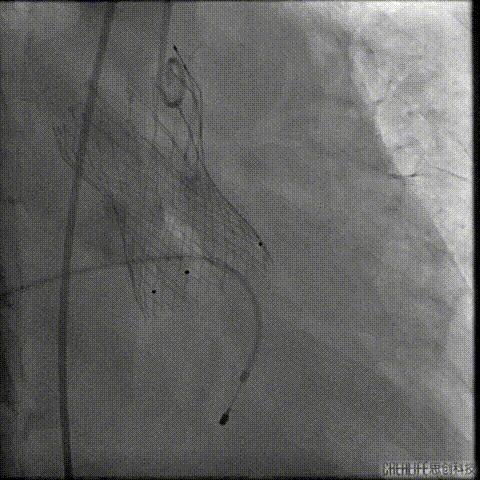 病例回顾与分享,腹膜后血肿介入治疗