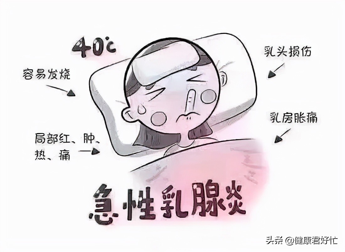 急性乳腺炎的一般疗法有哪些,急性乳腺炎西医治法