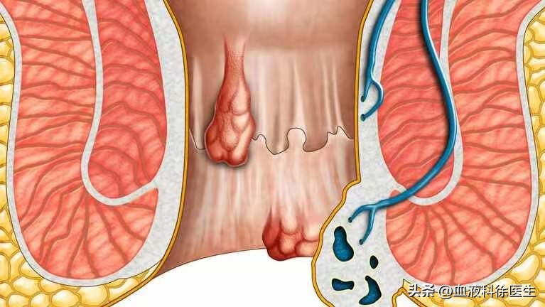 “难以启齿”的肛门病，你了解吗？下身有这3种异常，早做检查！