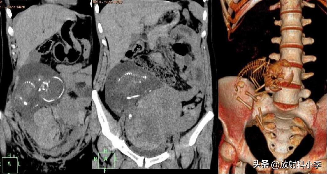 妇科急腹症的ct表现,妇科急腹症的诊断与治疗