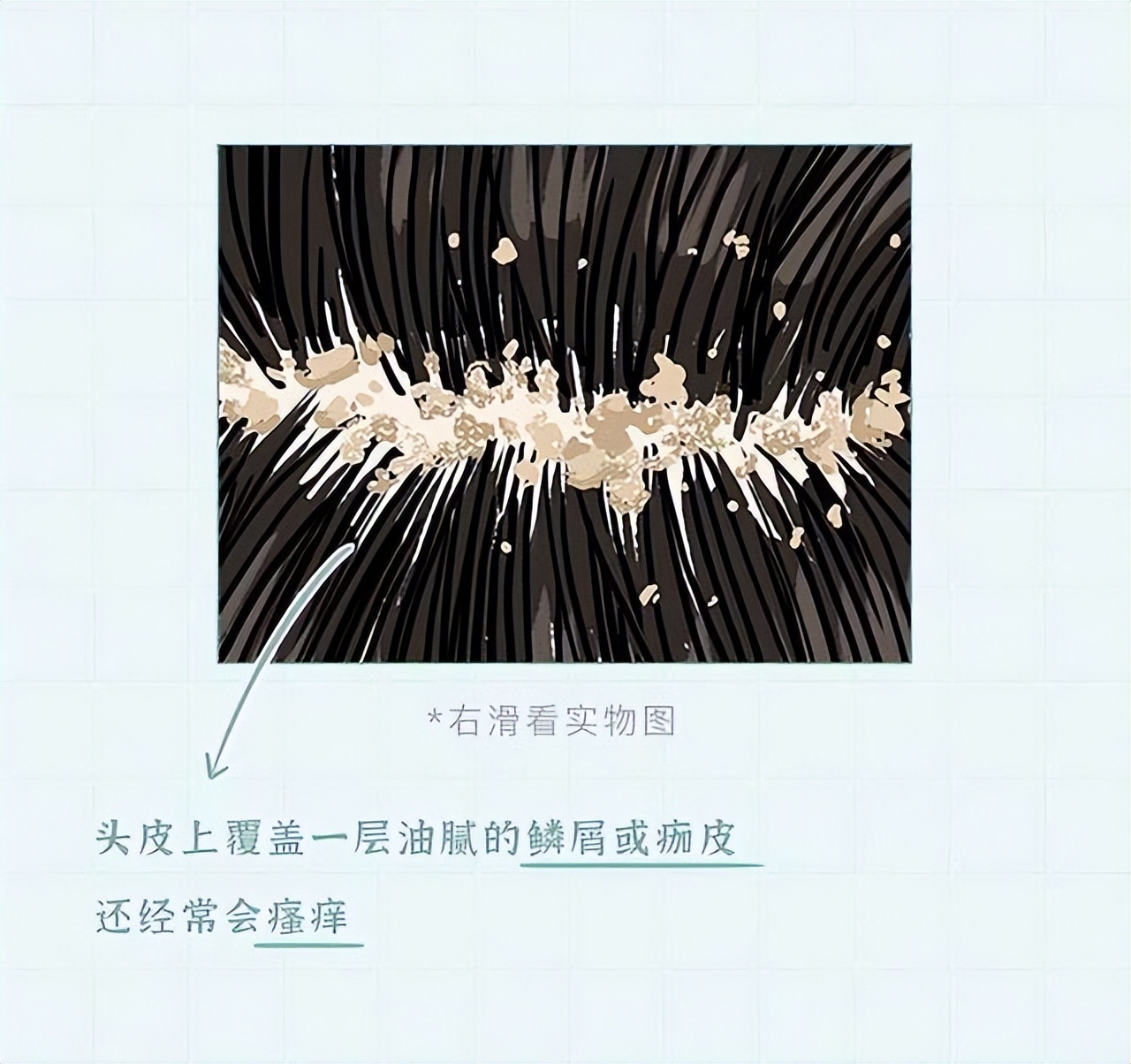 头皮上白色的颗粒是什么问题,头皮屑多是什么原因漫画