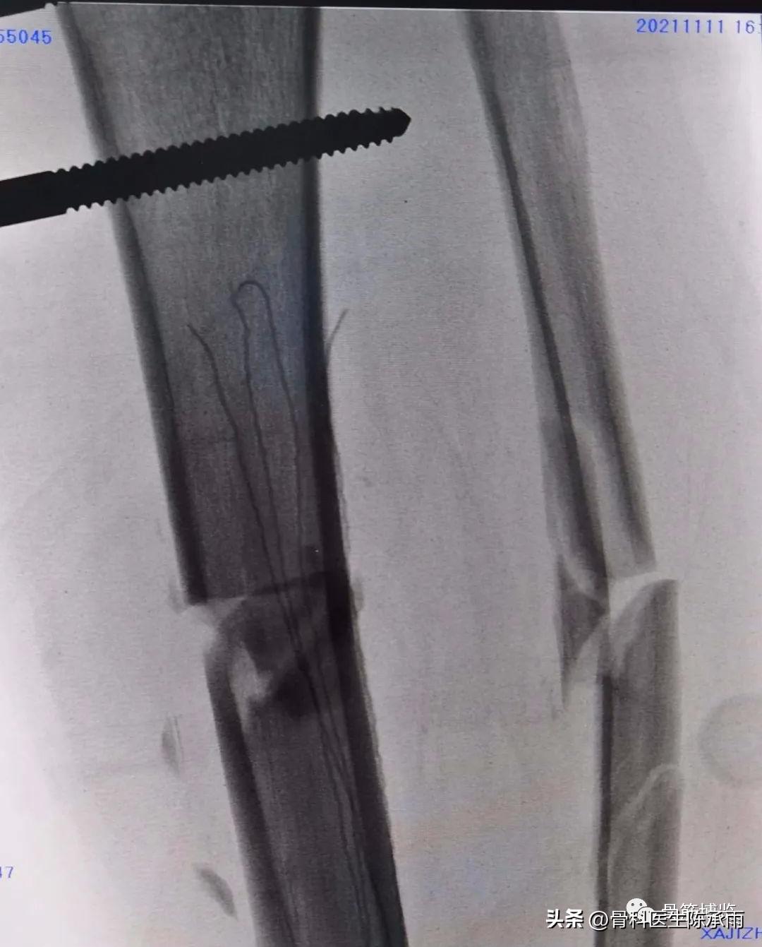 胫骨开放性骨折处理方法,胫骨腓骨开放性骨折能评几级伤残