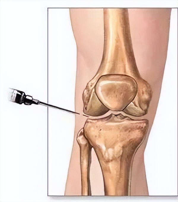 半月板损伤严重的状态是什么,半月板损伤应该注意什么问题
