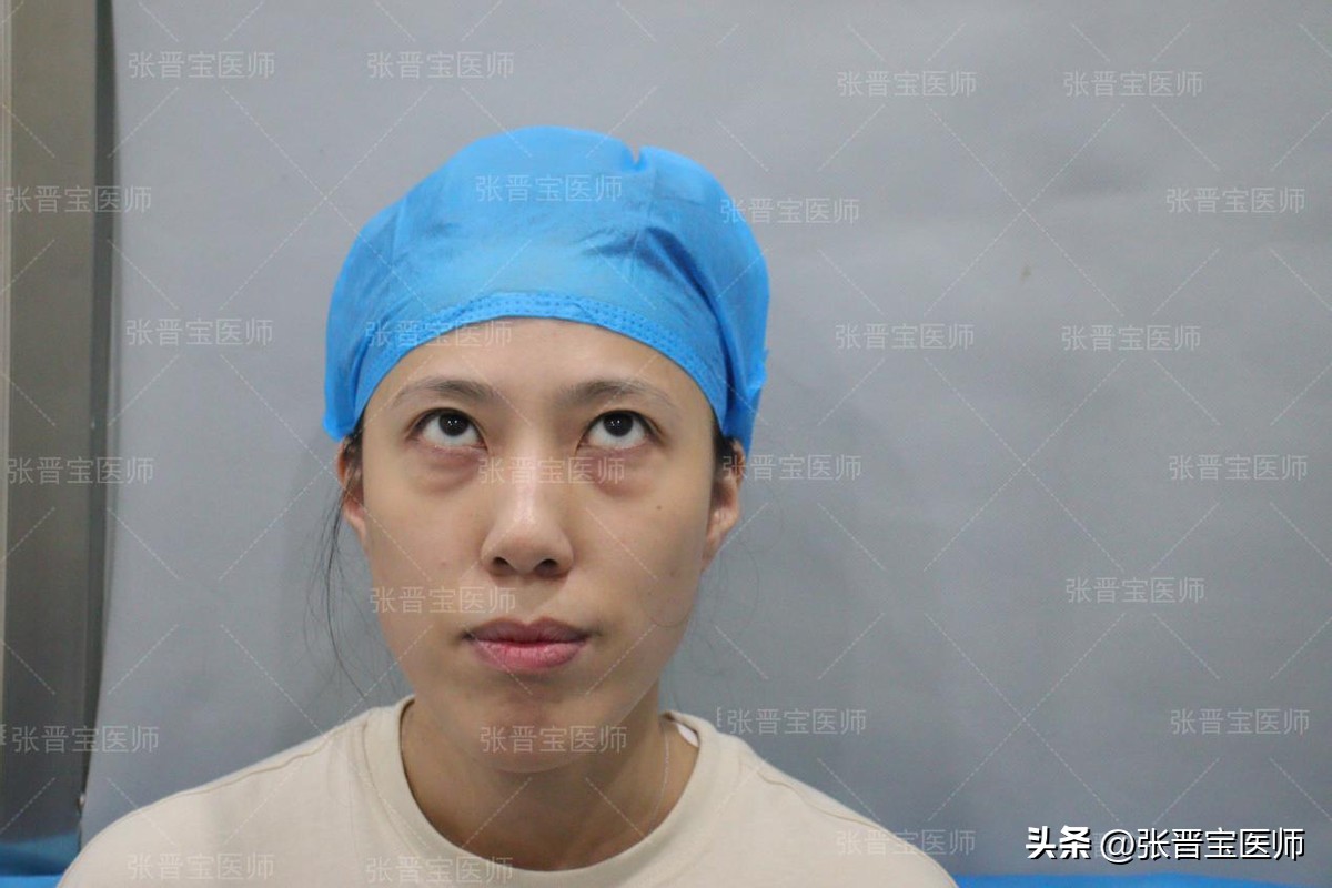 44岁女做眼袋切除适合吗,眼袋手术28岁