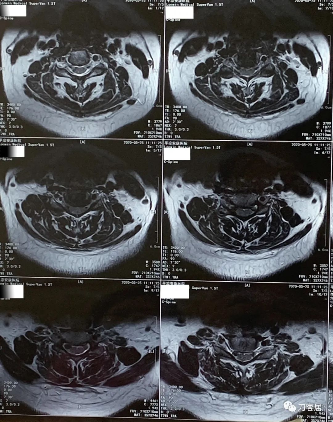 颈椎病十年了手臂酸痛肩背痛,颈椎病十年了一直痛怎么办