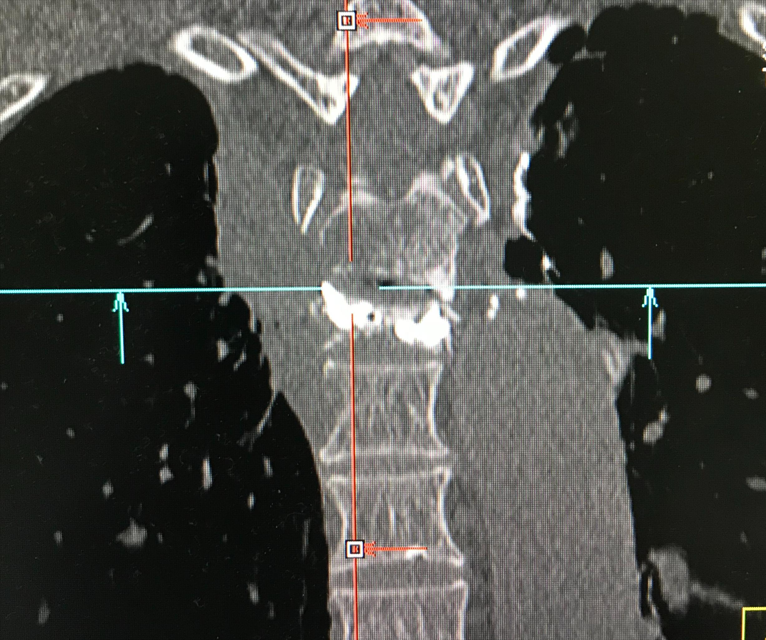 胸椎压缩性骨折微创手术利弊,胸椎压缩性骨折保守治疗20例
