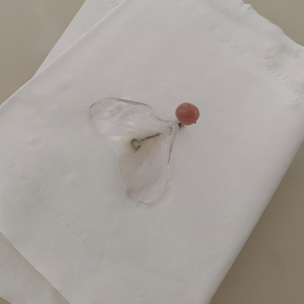 宝宝是一只“小兔子”，还没长牙就要开始正畸了