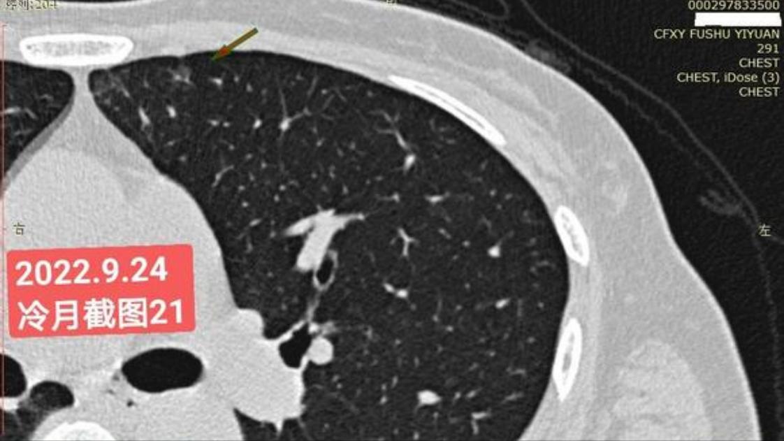 7mm肺结节恶性的怎么办,7mm实性肺结节危险程度