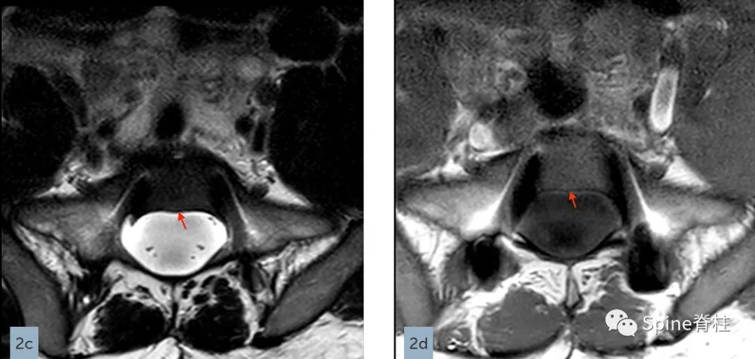 硬膜囊扩张是什么意思,硬膜囊扩张压迫神经