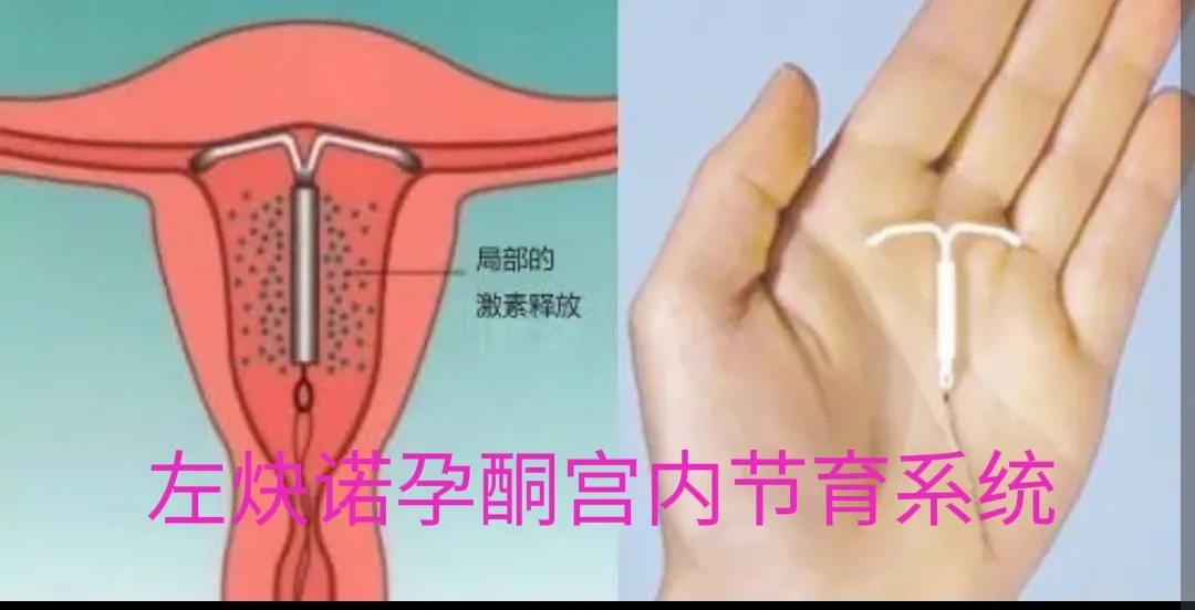 五花八门的节育环,各种节育环的价格和优点