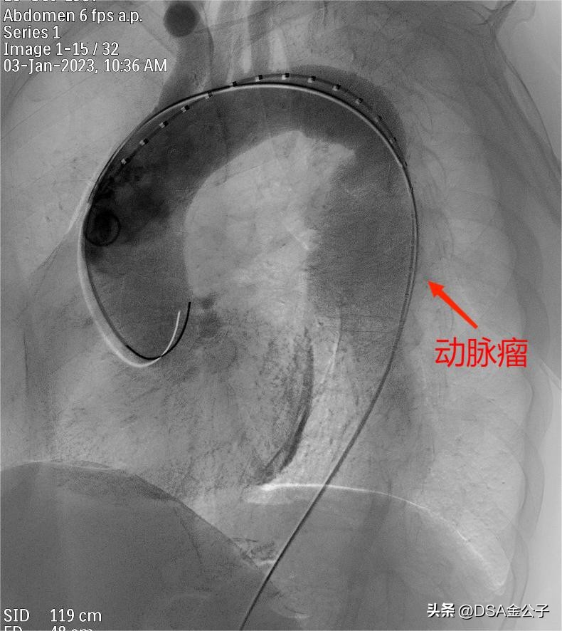 主动脉夹层动脉瘤的超声表现,主动脉夹层动脉瘤会左脚痛吗