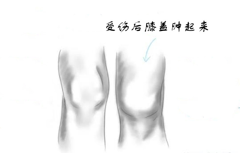 膝盖受伤要不要去包扎,膝盖受伤不能弯曲是什么问题