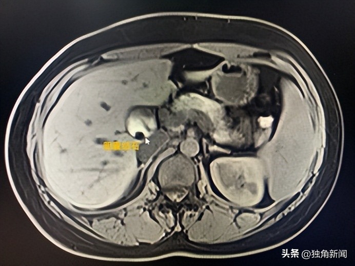 胆道微创,胆结石微创手术三个孔