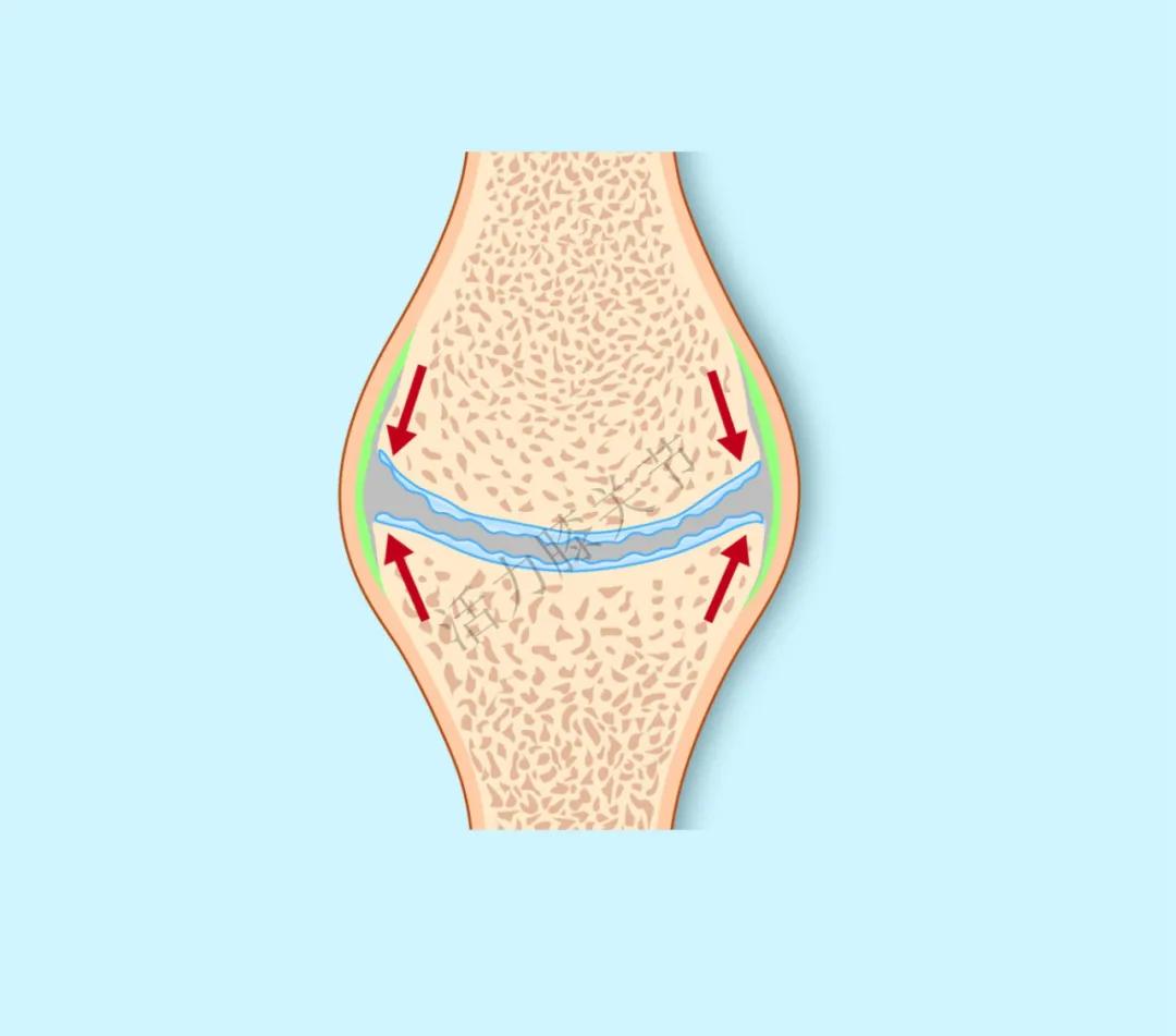 骨关节炎是如何产生的,骨关节炎的形成机制
