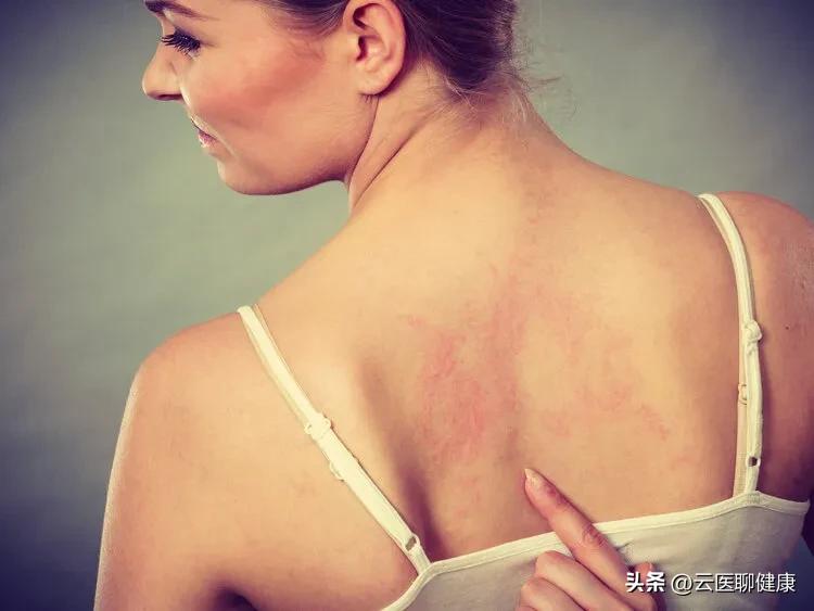 麻疹原因,麻疹由什么引起