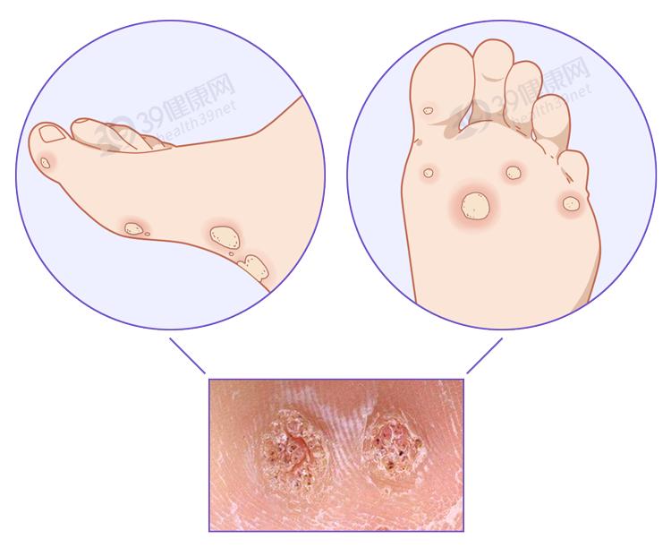 腋下长小肉粒是hpv感染吗,腋下长了一个丝状疣一定是hpv吗